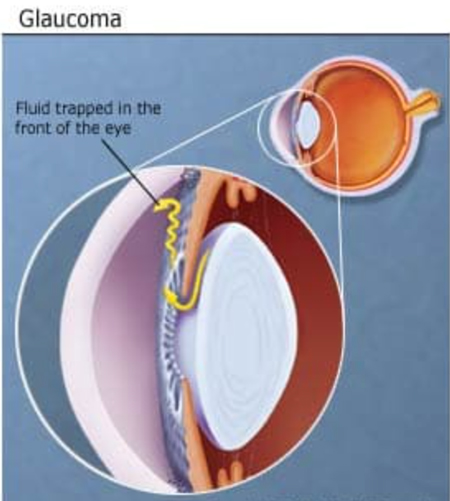 Glaucoma Diagram