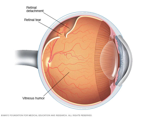 Retina Chart